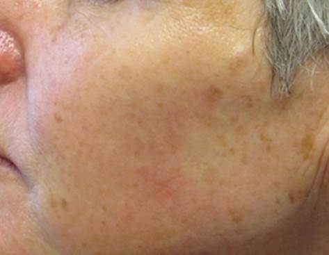Pigmentation After