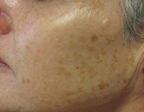 Pigmentation Before