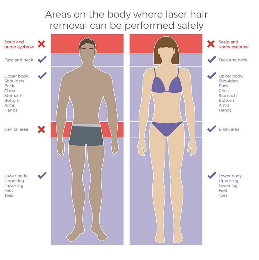 laser hair removal