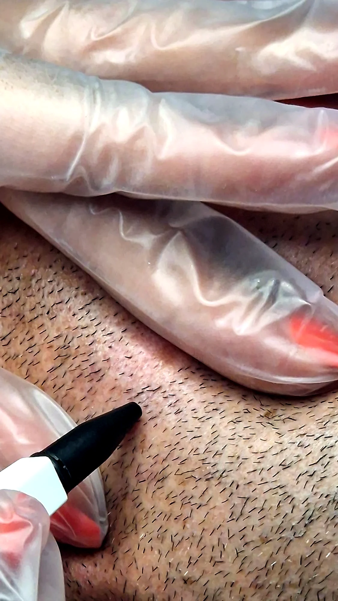 Gloved hands guiding the electrolysis probe to a hair on the jaw