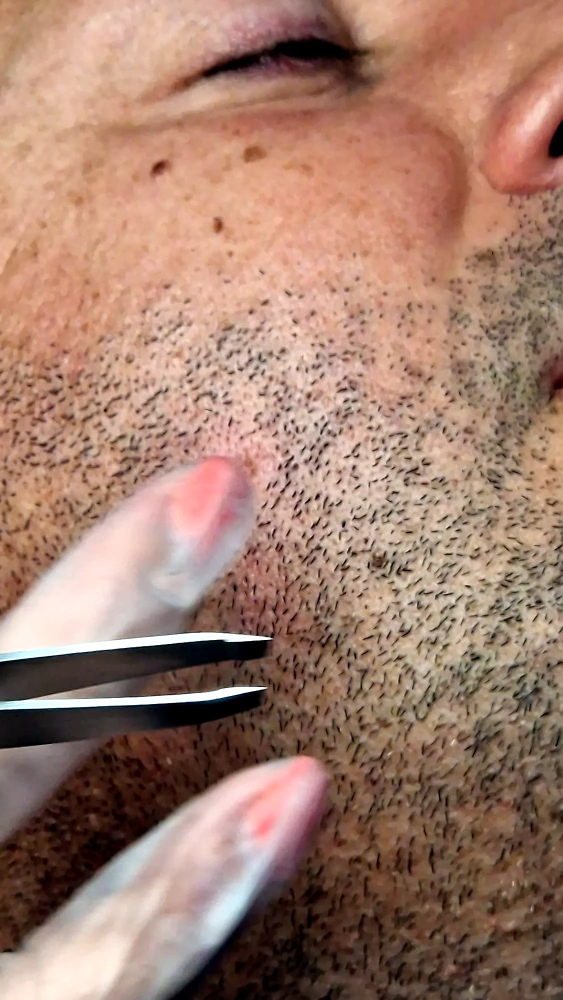 Tweezers lifting a treated hair from the jaw