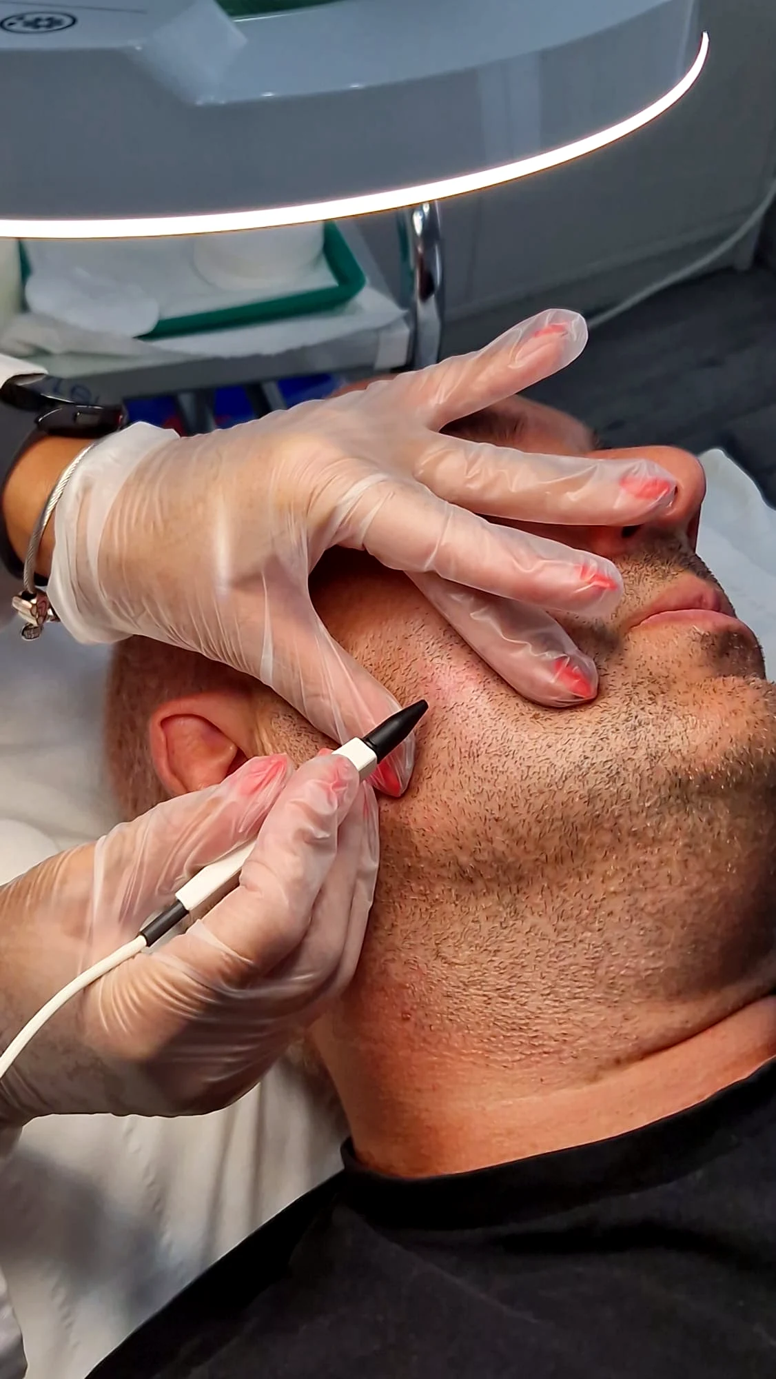 Electrologist treating the jaw with the probe, skin held taut with the other hand