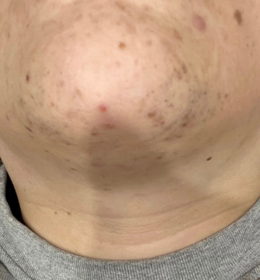 before laser hair removal - ingrown hairs